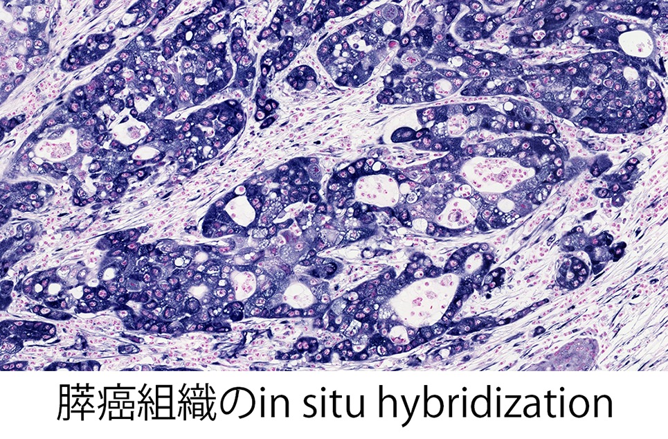 膵腫瘍におけるmiRNAの発現解析と新規診断・治療法への応用
